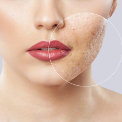 Acne & Littekens behandeling