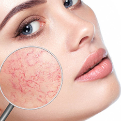 Couperose behandeling